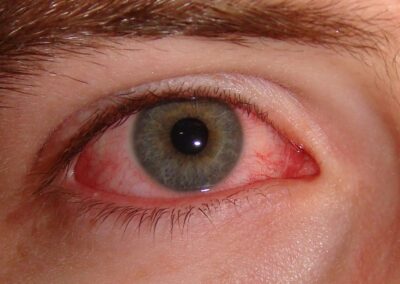 Redness in Eyes