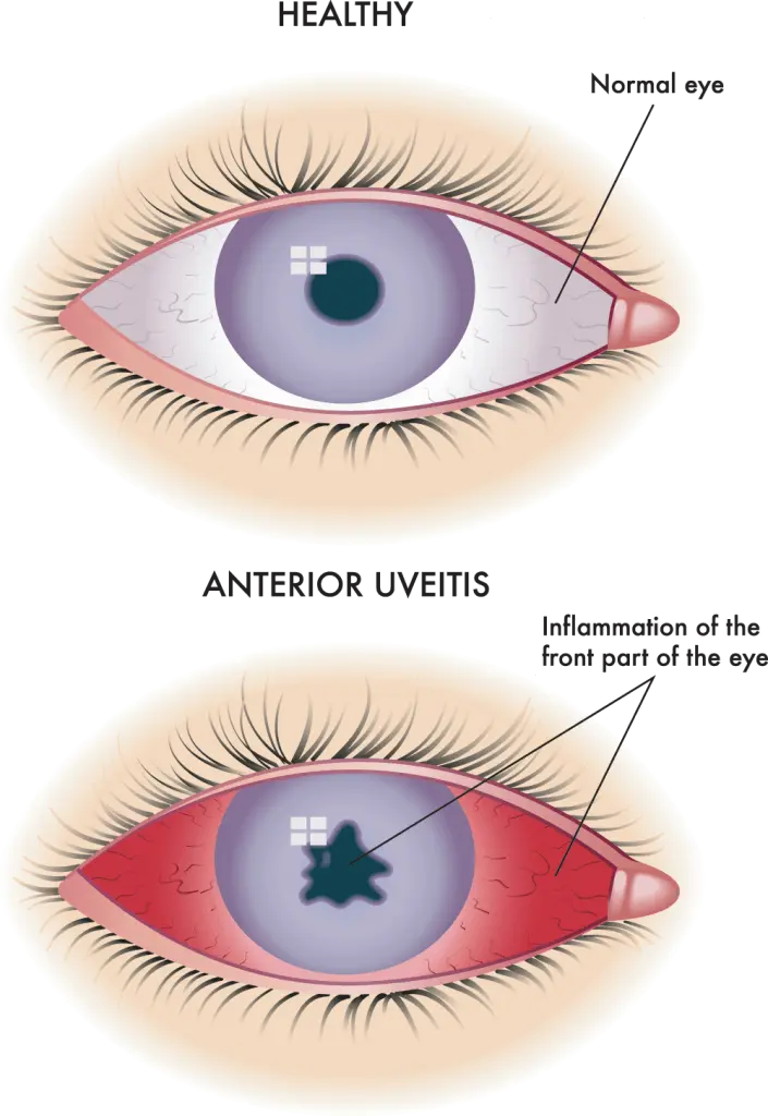 anterior-uveitis-705x1024