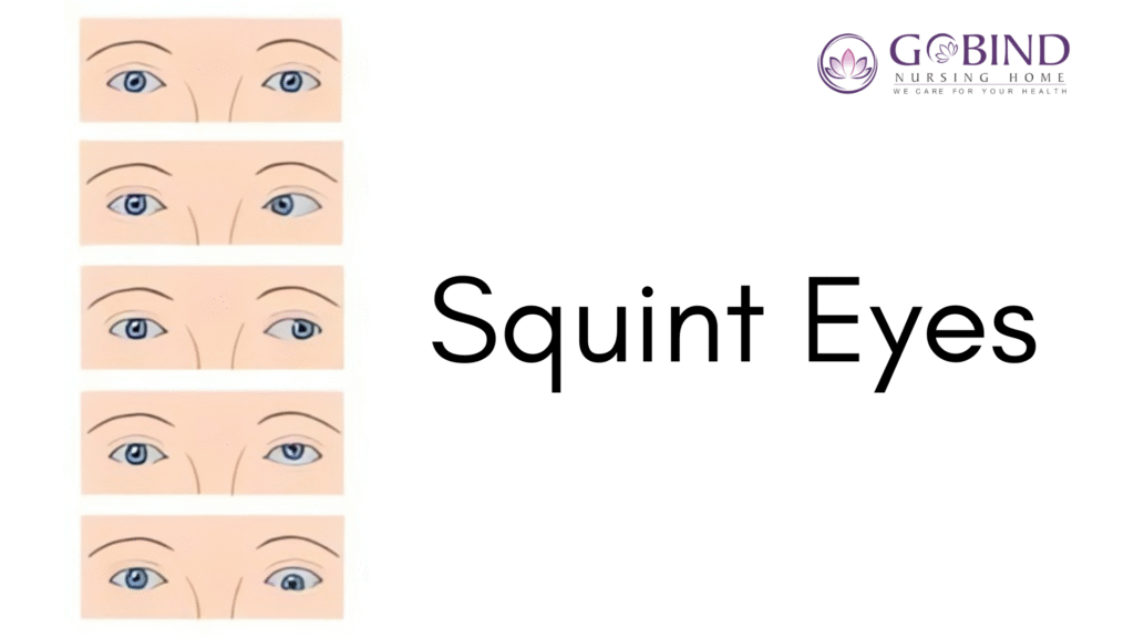 Squint correction without surgery at Gobind Eye Care for better eye alignment and clear vision.