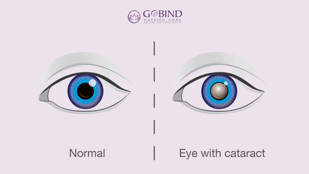Comparison of a normal clear eye and an eye with cataract showing cloudy lens and blurred vision.