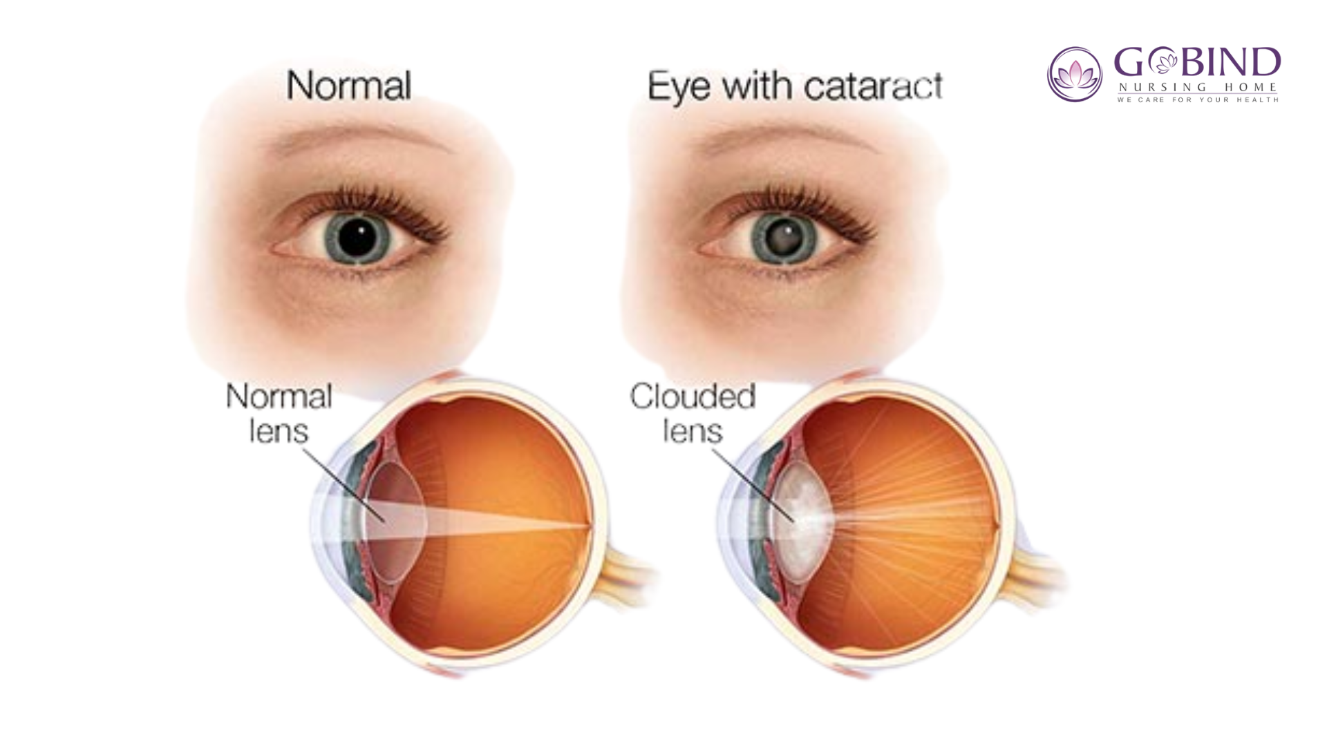 Normal lens or clouded lens showing clarity and cataract formation.