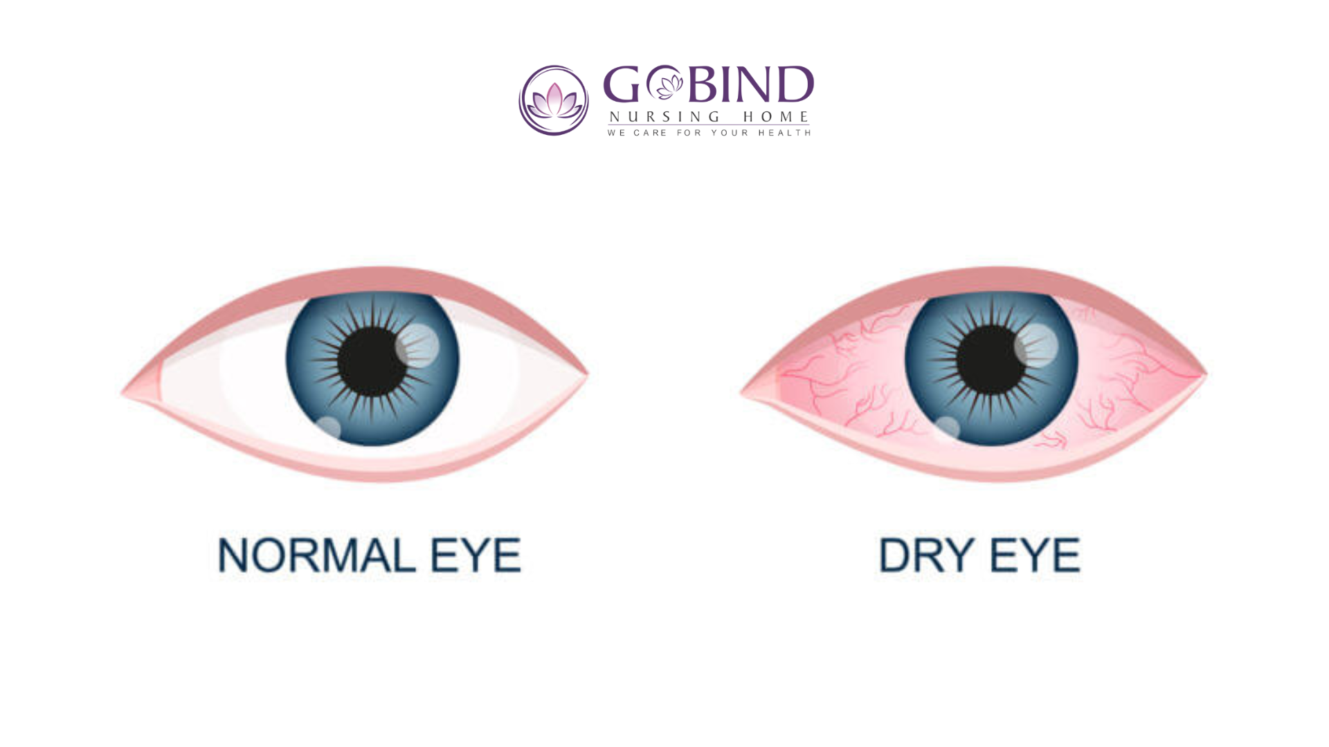 Comparison of normal eyes and dry eyes at Gobind Eye Care