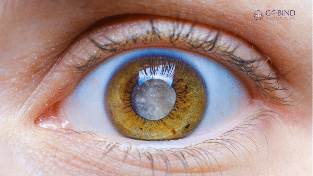 Eye affected by cataract due to prolonged sun exposure