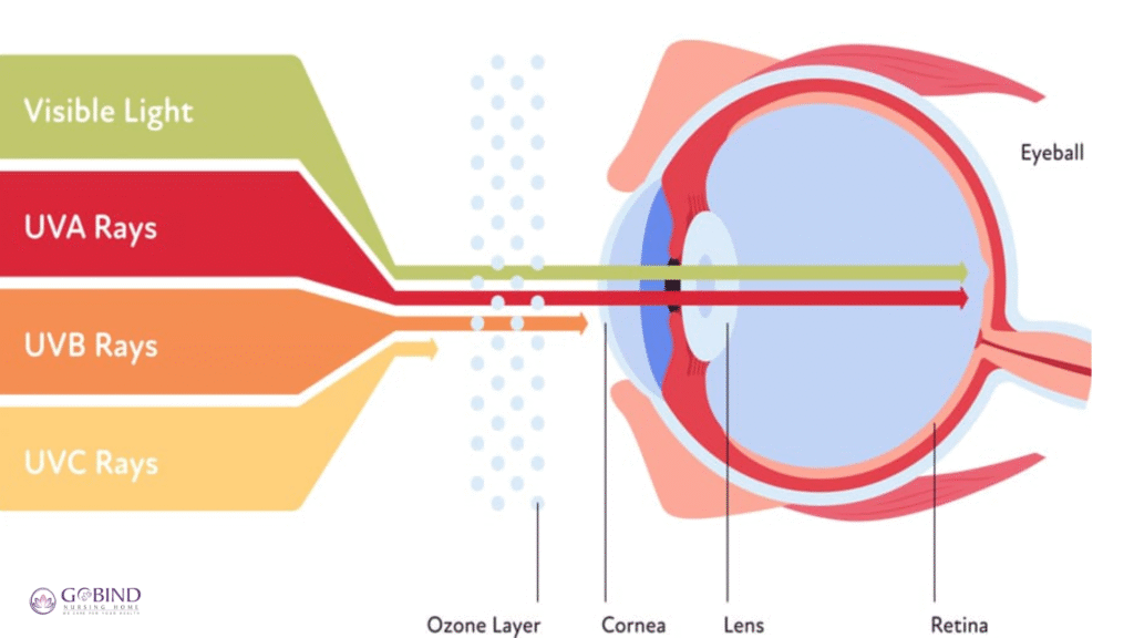UV radiation effects on the eye lens causing cataracts