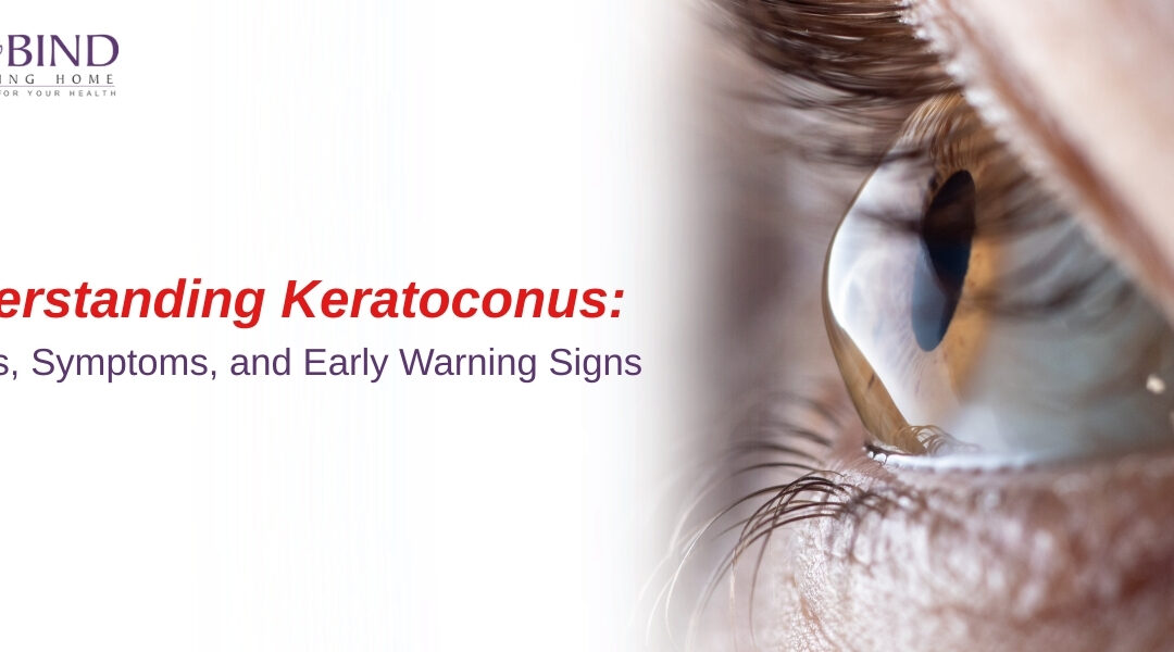 Close-up image of an eye showing corneal bulging, representing keratoconus, with text reading ‘Understanding Keratoconus: Causes, Symptoms, and Early Warning Signs’ for Gobind Eye Care.