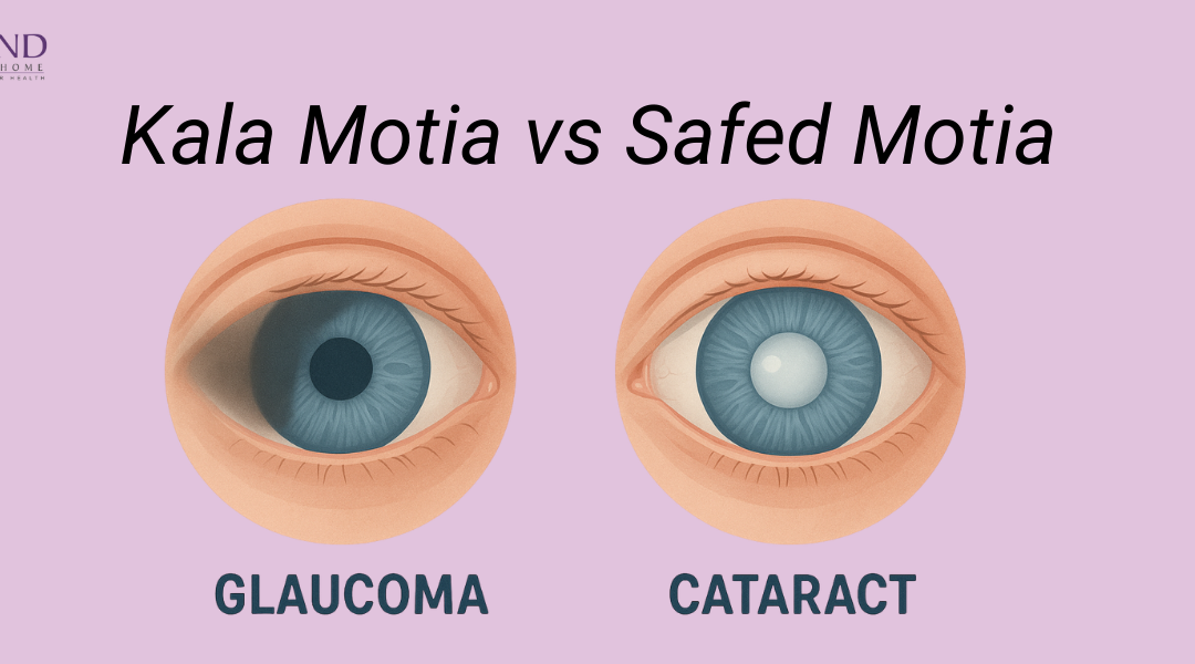 Kala Motia (Glaucoma) vs Safed Motia (Cataract) comparison showing differences in vision loss and eye condition