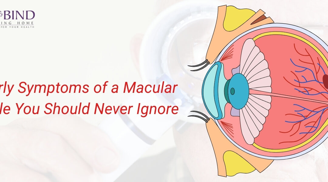 Illustration of the eye showing macular hole early symptoms such as central vision distortion and blurred vision.