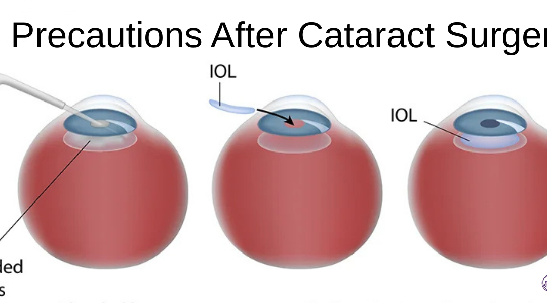 Precautions After Cataract Surgery: A Complete Guide by Gobind Eye Care Centre