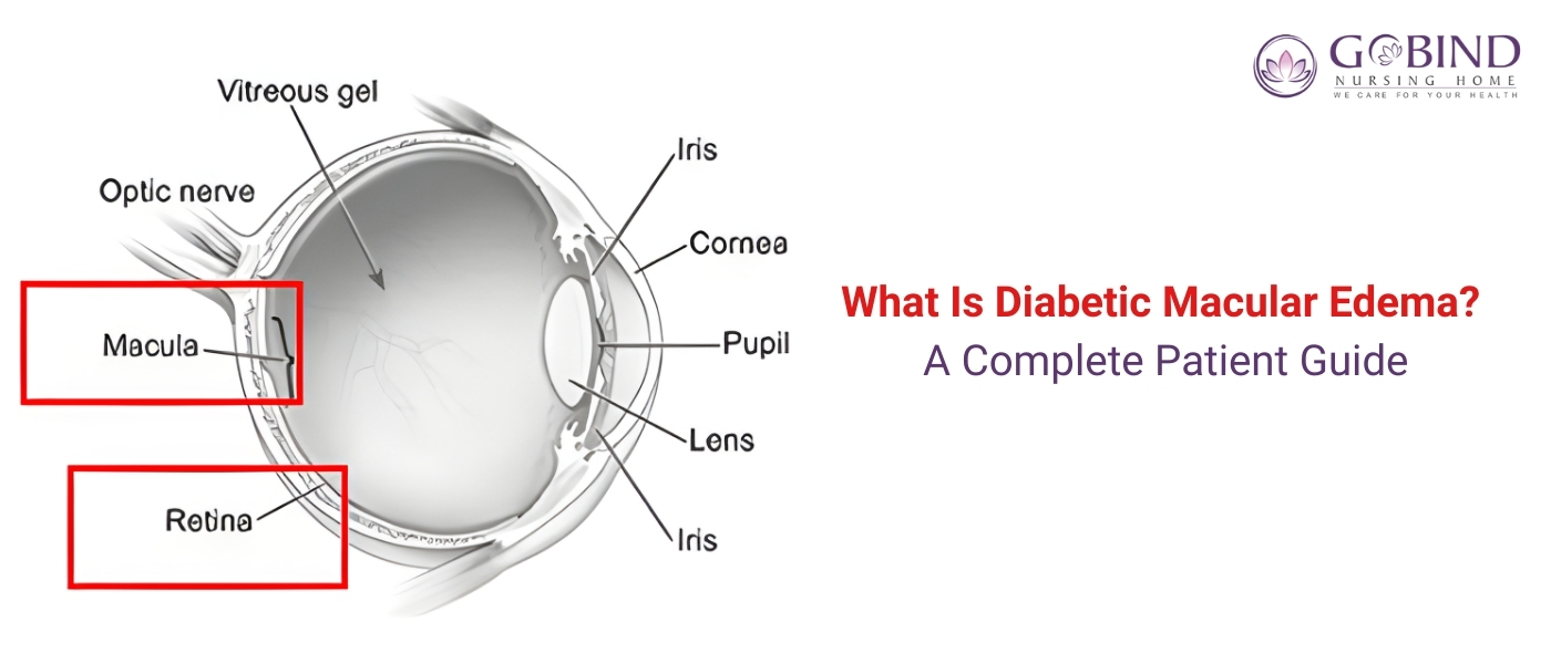 “Eye anatomy showing retina and macula with labels – featured image explaining Diabetic Macular Edema”