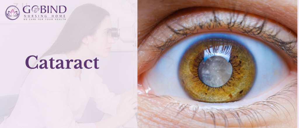 A cataract develops when the natural lens of the eye becomes cloudy. Cataracts commonly cause blurred or hazy vision, glare, and difficulty seeing clearly.