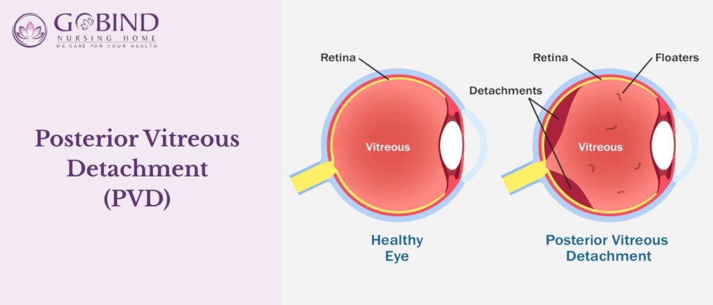 One of the most common causes of flashes is Posterior Vitreous Detachment.