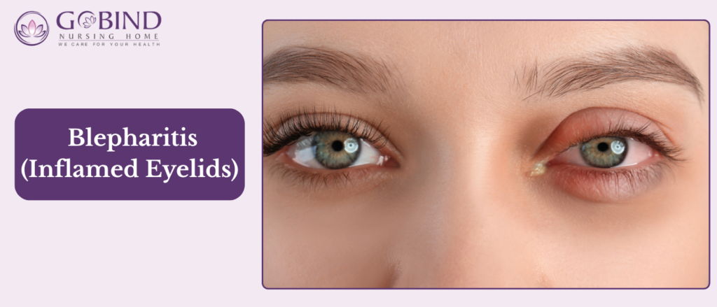 Blepharitis is a common condition where the edges of the eyelids become inflamed due to bacteria or blocked oil glands.