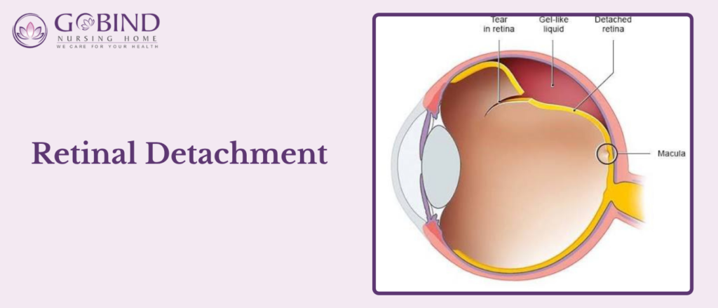 Retinal detachment occurs when the retina separates from the back of the eye.