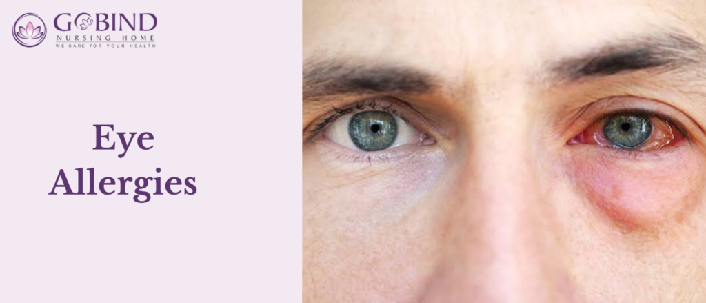 Eye allergies